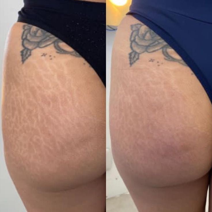 RenewSkinPatch – Fade Scars & Wrinkles While You Sleep - Renewskin