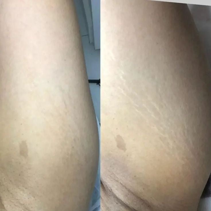 RenewSkinPatch – Fade Scars & Wrinkles While You Sleep - Renewskin