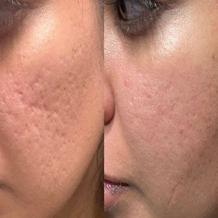 RenewSkinPatch – Fade Scars & Wrinkles While You Sleep - Renewskin