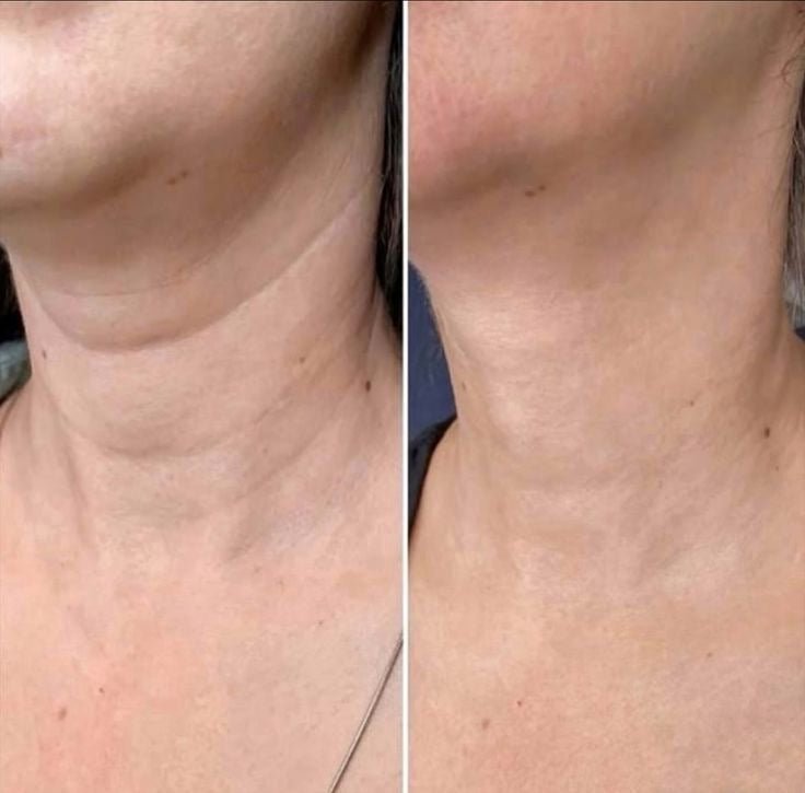 RenewSkinPatch – Fade Scars & Wrinkles While You Sleep - Renewskin