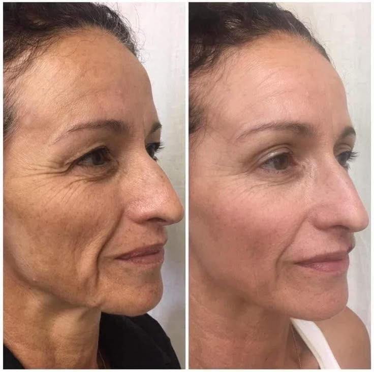 RenewSkinPatch – Fade Scars & Wrinkles While You Sleep - Renewskin
