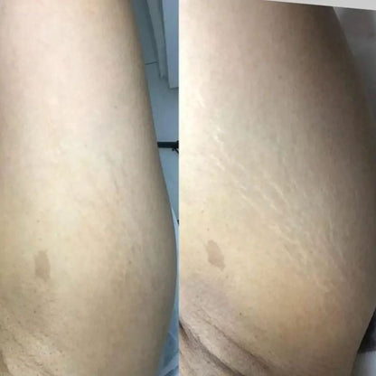 RenewSkinPatch – Fade Scars & Wrinkles While You Sleep - Renewskin