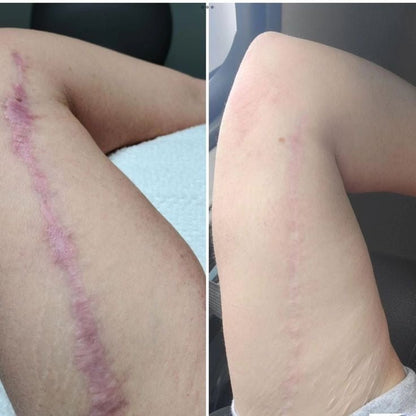 RenewSkinPatch – Fade Scars & Wrinkles While You Sleep - Renewskin